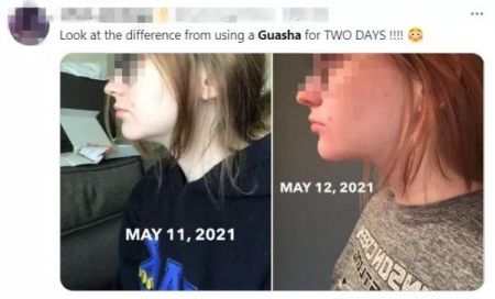 网友分享刮痧成果 网友分享刮痧成果